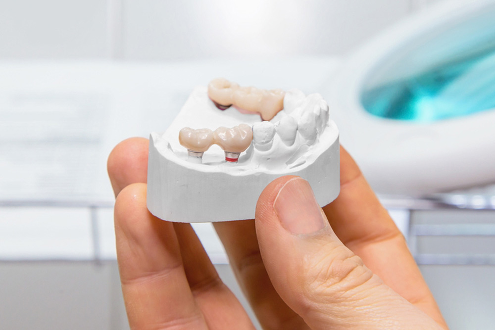 Available Arise packet Quanto costa un ponte dentale? Studio Dentistico Acilia - Dott.ssa Greco