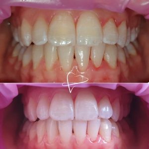 prima e dopo sbiancamento denti studio dentistico acilia