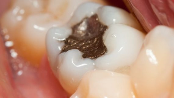 amalgama dentale pericoloso rimozione costo