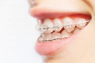 ortodonzia fissa estetica: soluzione per sorrisi dritti e smaglianti