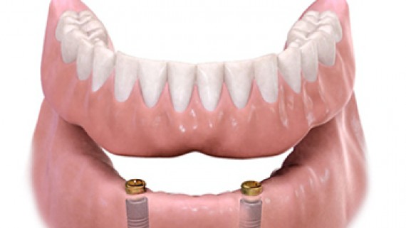 protesi dentaria mobile senza palato