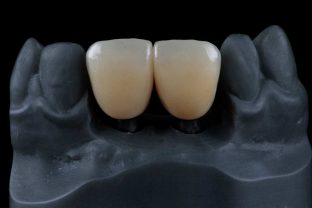 protesi dentale fissa in zirconia