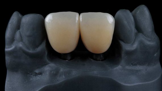 protesi dentale fissa in zirconia